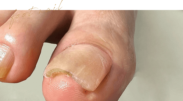 フットネイル